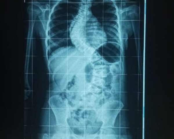Exames de radiografia mostram o grau avançado de escoliose na coluna da Maria Eduarda Machado