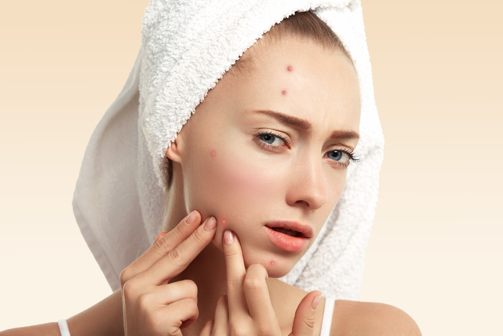 Problemas com acne? Dermatologistas explicam motivo e como tratar