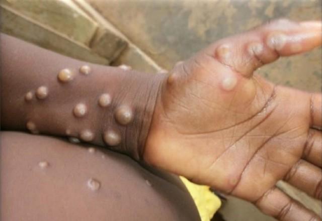 Número de casos de varíola dos macacos chegam a 37 em Portugal