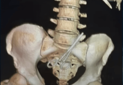 Tesoura esquecida no abdômen do homem após a cirurgia. Foto: Primeiro Impacto | Reprodução