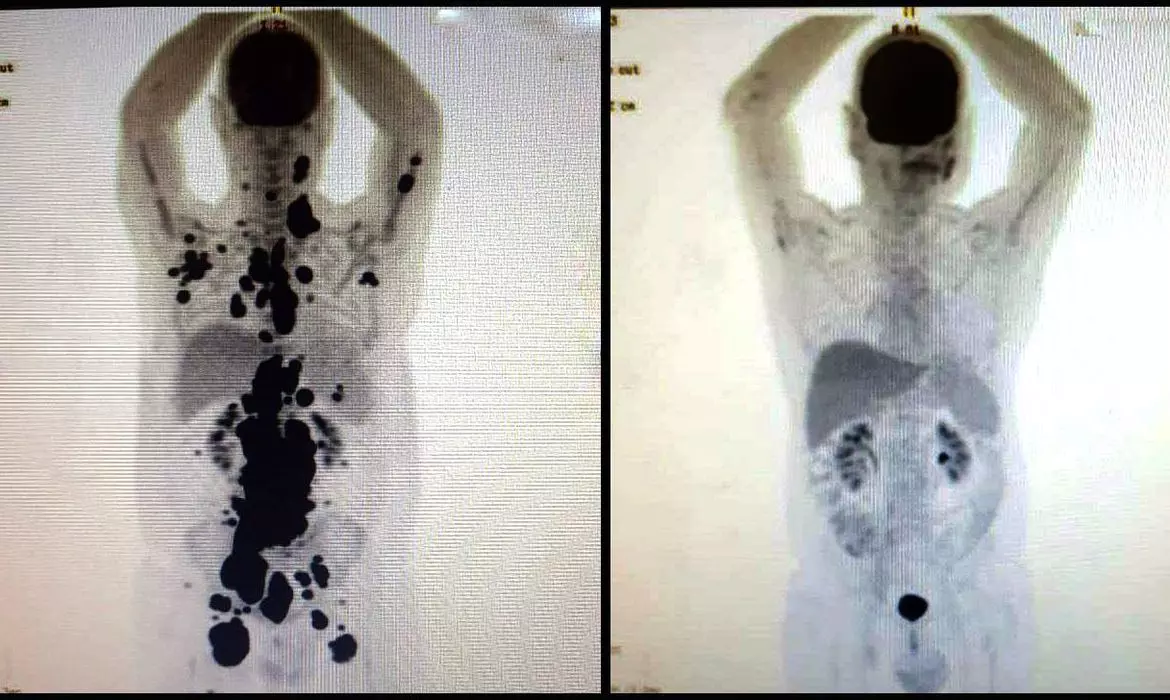 Com a terapia celular CAR-T Cell, o paciente Paulo Peregrino, 61 anos, teve remissão completa de um linfoma em apenas um mês. Foto: Arquivo pessoal