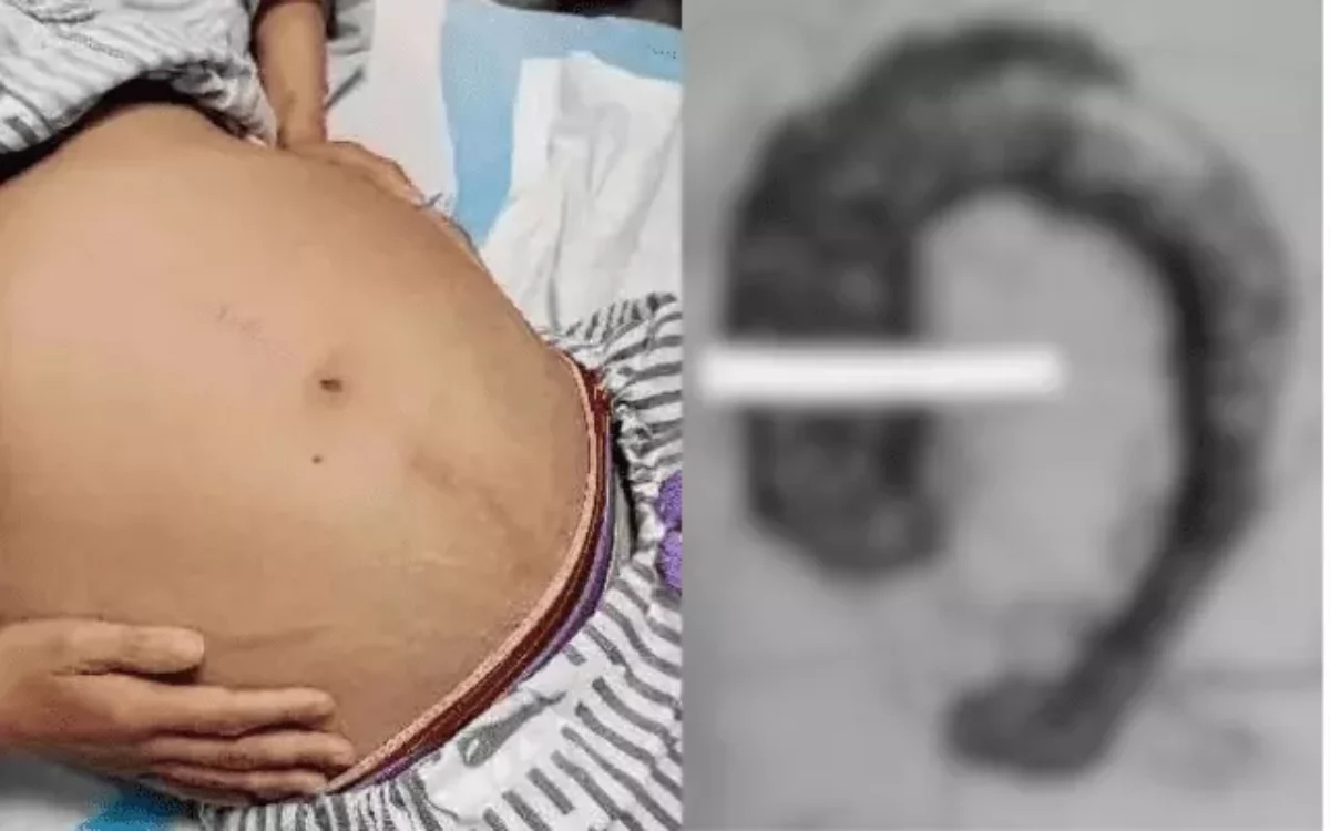 Mulher sente dor insuportável e descobre cocô gigante de 20 kg no intestino