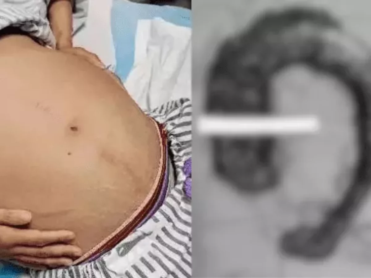 Mulher sente dor insuportável e descobre cocô gigante de 20 kg no intestino