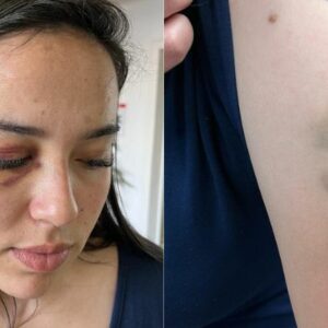 Fotógrafa de Lages foi brutalmente agredida durante uma partida de futsal | Foto: Carolina Sott/Rádio Clube de Lages