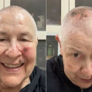 Representante do Zen Budismo no Brasil mostrou feridas no rosto e na cabeça e contou que está fazendo quimioterapia localizada