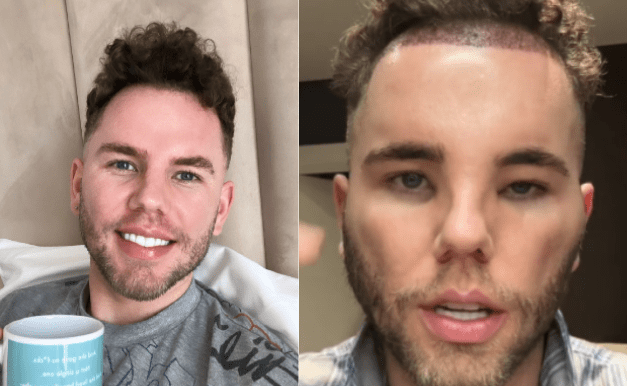 Transplante de cabelo deixa homem "parecendo um Avatar"