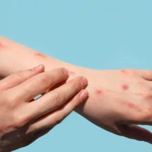 Casos de Mpox estão sendo monitorados em SC. - Sociedade Brasileira de Dermatologia/Reprodução