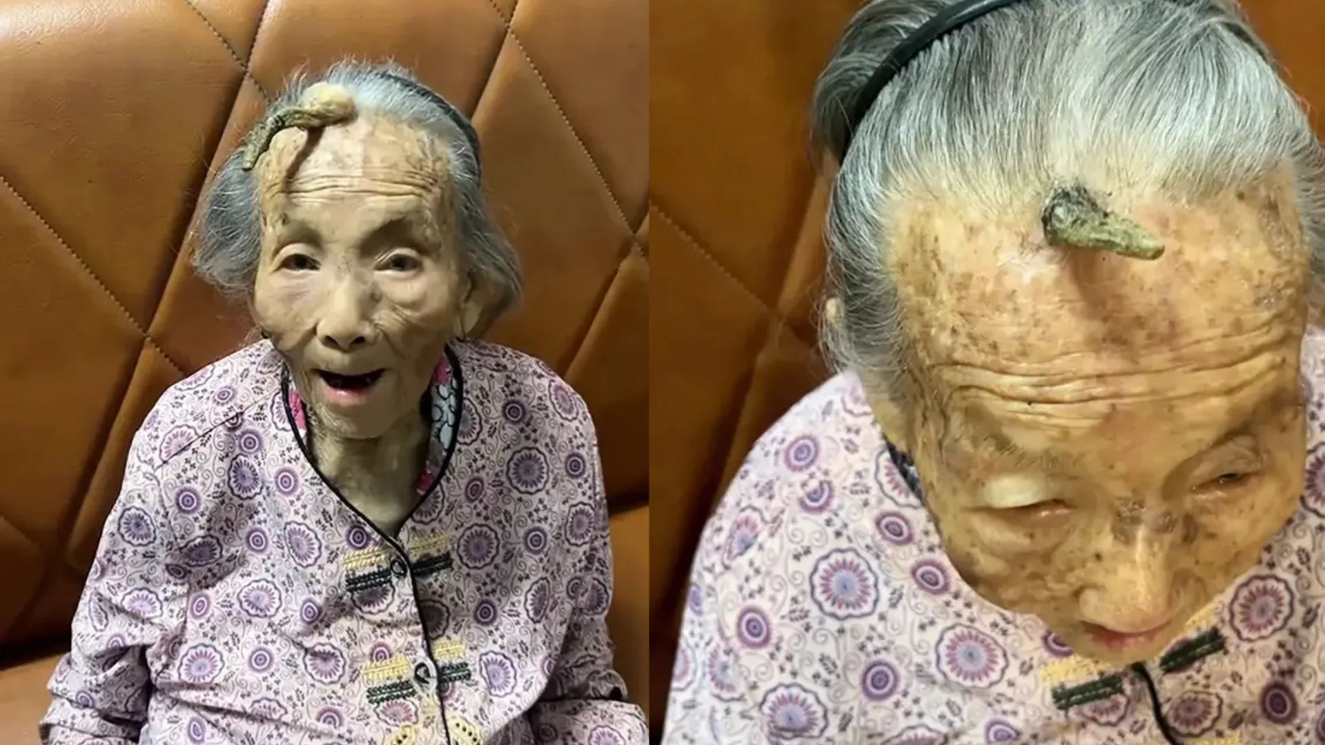 Idosa de 107 anos chama atenção por ‘chifre’ crescendo na testa | Foto: Reprodução/Redes Sociais 