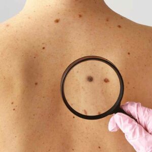 Dermatologistas realizam ação de combate ao câncer de pele