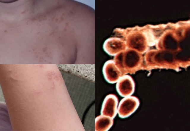 O que é “piolho-do-mar” que provoca coceiras e tem aparecido em crianças   | Foto: Reprodução/Revista Brasileira de Dermatologia e Arquivo Pessoal, via SBT News