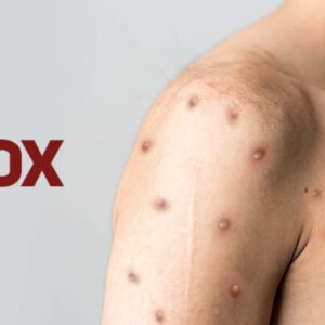 Itapema registra novo caso de Monkeypox e reforça alerta à população | Foto: Diretoria de Vigilância Epidemiológica (DIVE).