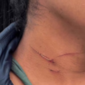 Moradora de SC quase tem pescoço degolado por linha com cerol - Imagem: redes sociais