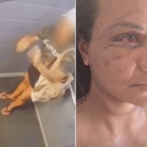 Juliana Soares mostra como está o rosto após cirurgia de reconstrução | Imagem: Reprodução/Redes Sociais