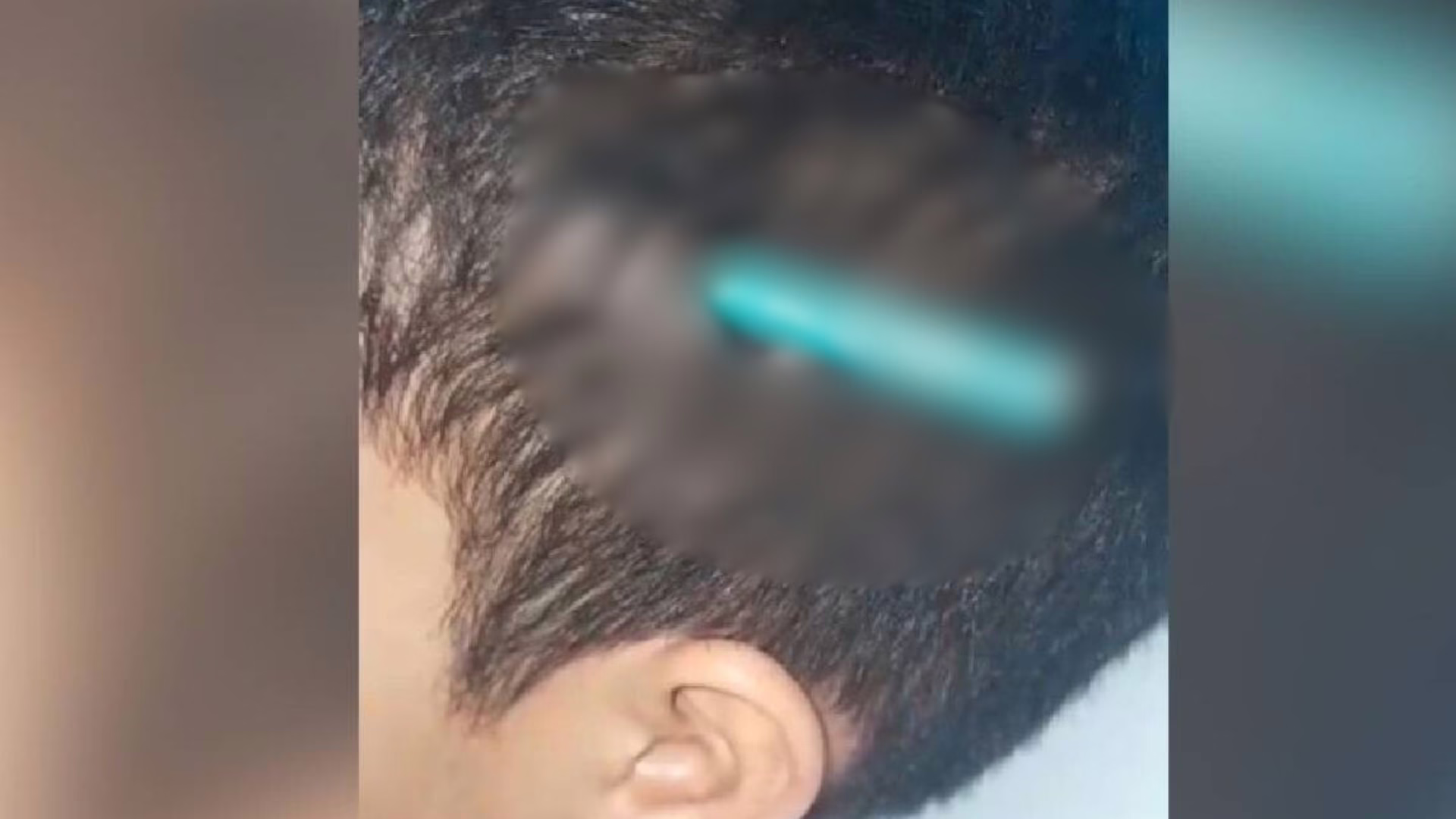Aluno é atacado com lápis na cabeça após briga em escola – Imagem: reprodução/ Massa