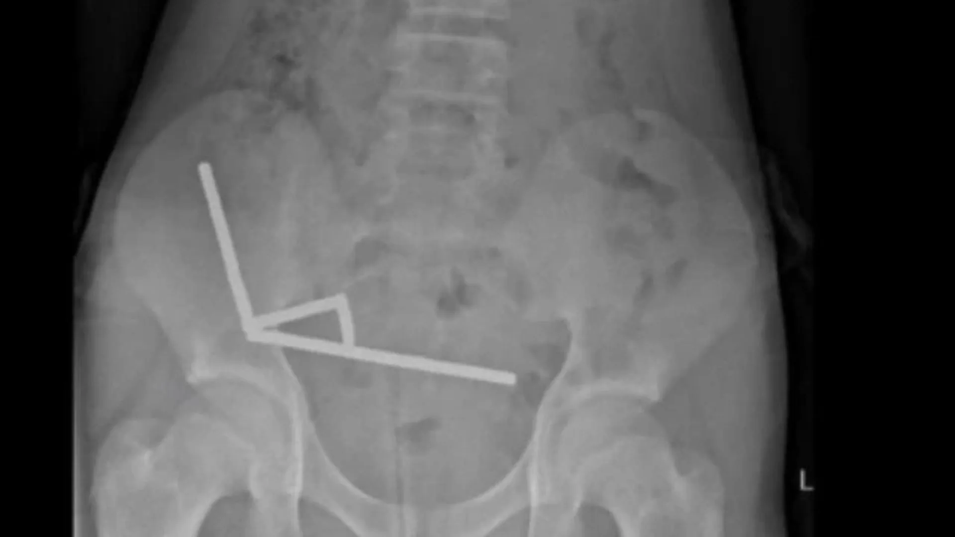 Após ingerir 100 ímãs, menino perde parte do intestino | Foto: New Zealand Medical Journal | SBT News Após ingerir 100 ímãs, menino perde parte do intestino | Foto: New Zealand Medical Journal | SBT News