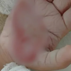 'Queria castigar': mulher queima mão de criança com colher quente em SC