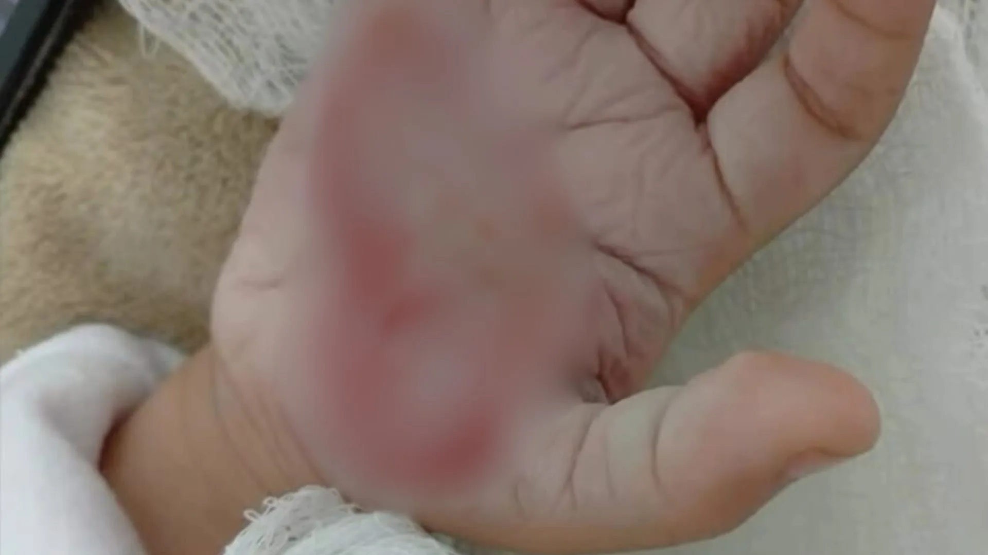 ‘Queria castigar’: mulher queima mão de criança com colher quente em SC | Foto: Repórter Paulo Roberto/Reprodução ‘Queria castigar’: mulher queima mão de criança com colher quente em SC | Foto: Repórter Paulo Roberto/Reprodução