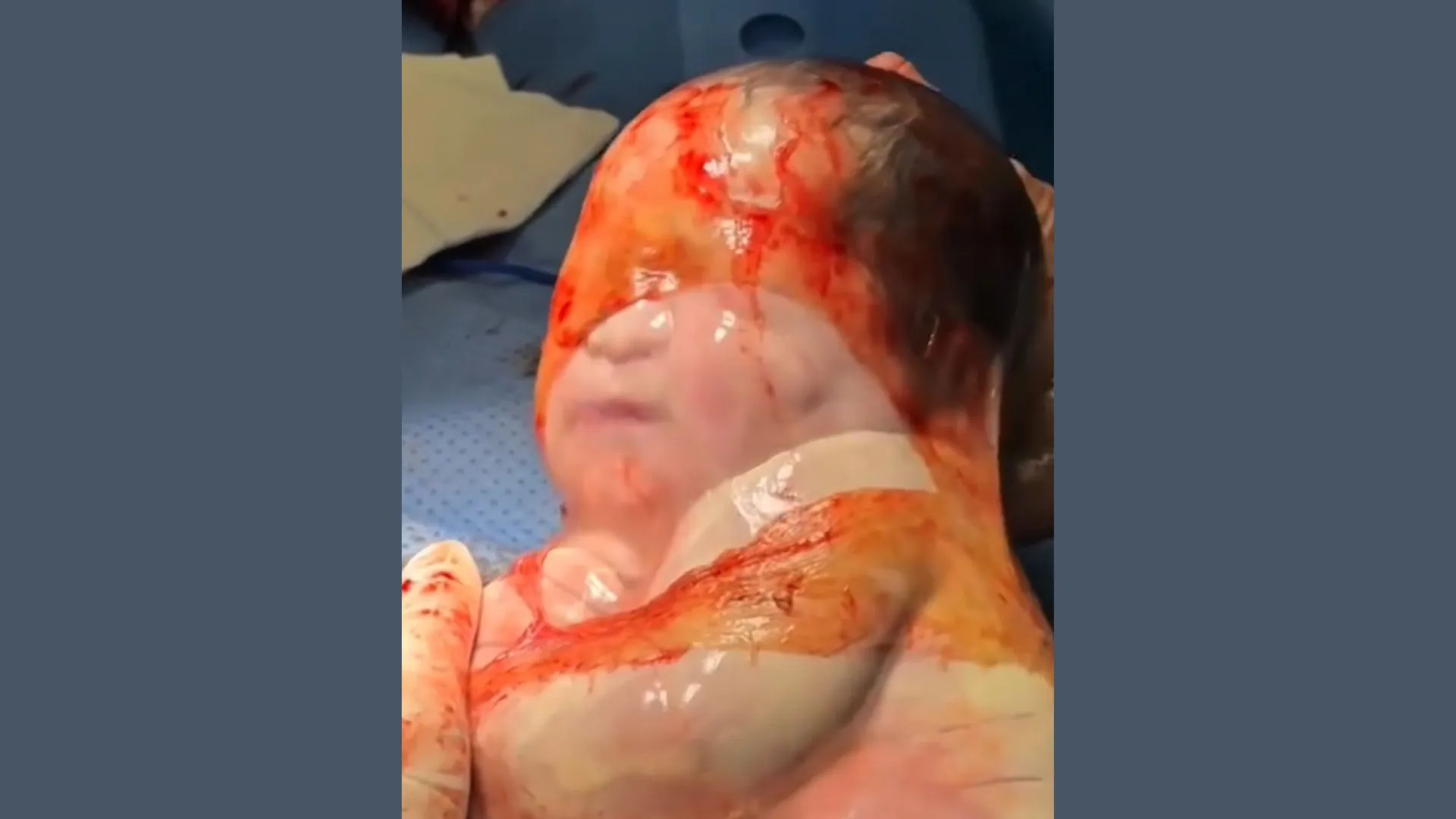 VÍDEO: bebê nasce empelicada em um parto raro em SC | Foto divulgação | Hospital Divino Salvador 