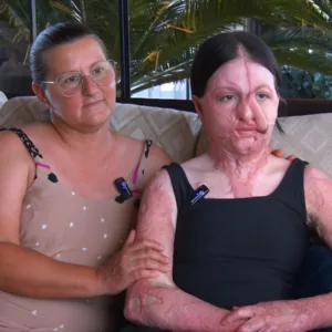 Ariella Melissa que teve 60% do corpo queimado começa tratamento em Araranguá | Foto: Isaque Lúcio/SCC SBT 