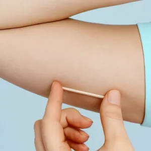 Lages inicia oferta de implante contraceptivo subdérmico na rede municipal de saúde | Imagem ilustrativa