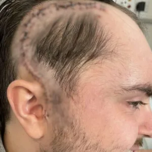 Homem confunde sinais de câncer cerebral com dor muscular e descobre tumor após convulsão - Imagem: reprodução/ metrópoles