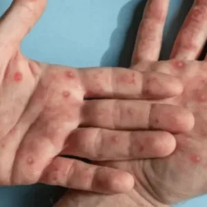 Brasil registra 81 casos de mpox