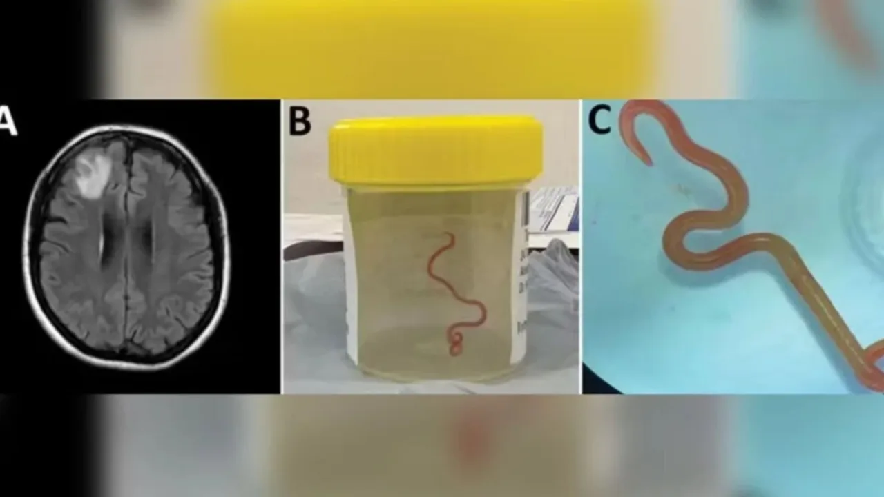 Verme de cobra é encontrado pela 1ª vez no cérebro humano