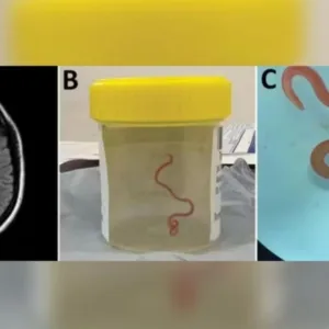 Verme de cobra é encontrado pela 1ª vez no cérebro humano