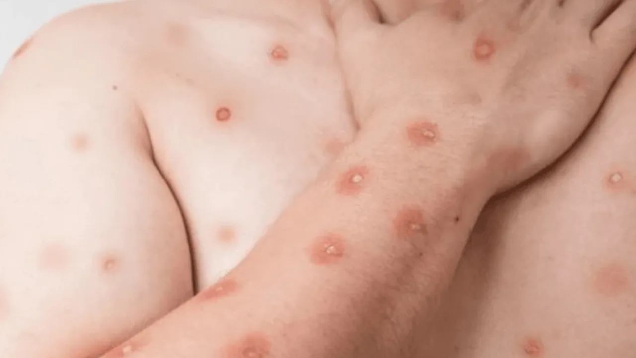 Mpox: entenda os sintomas e o risco de surto