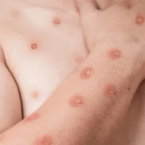 Mpox: entenda os sintomas e o risco de surto - Imagem: reprrodução/ SBT