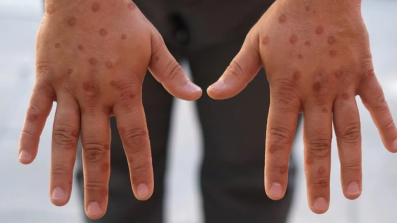 Casos de Mpox em SC seguem sob controle, afirma SES