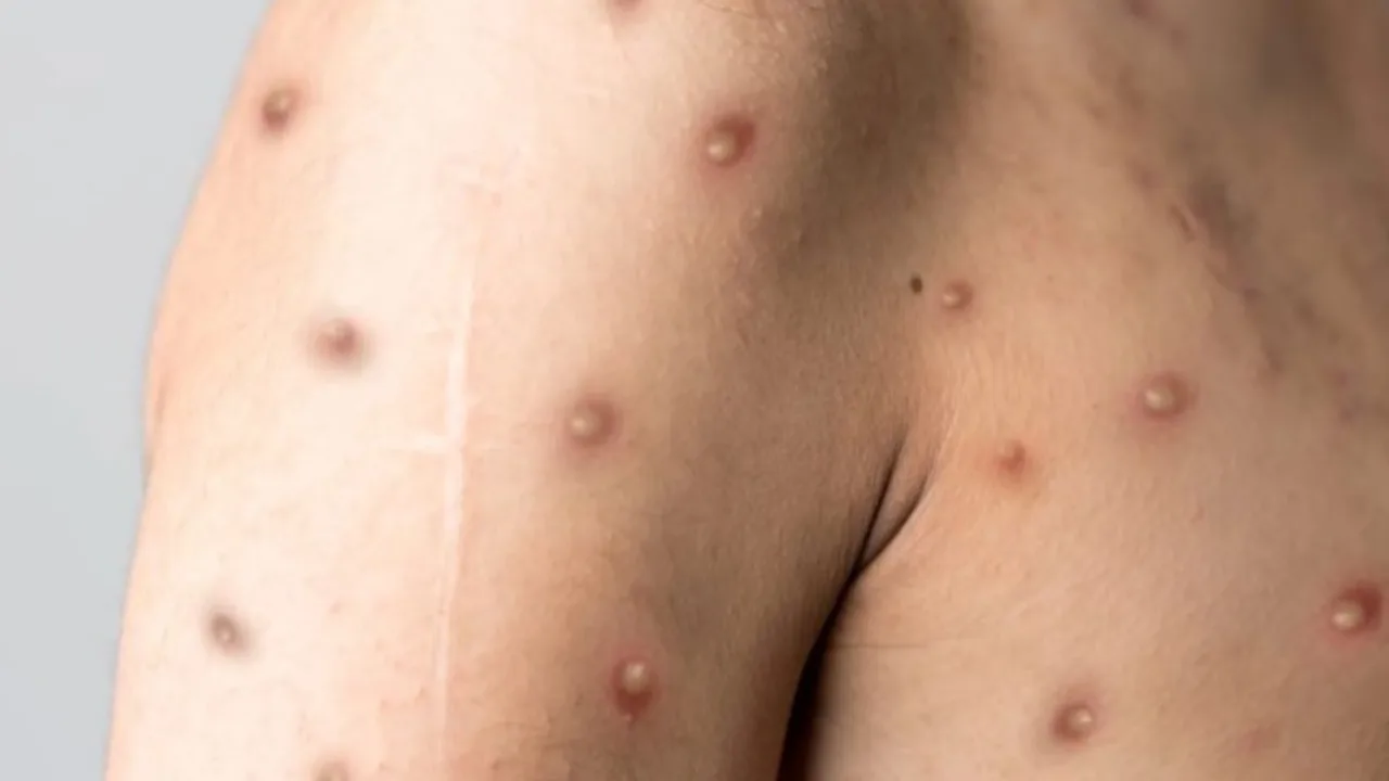 Porto Alegre confirma primeiro caso de mpox