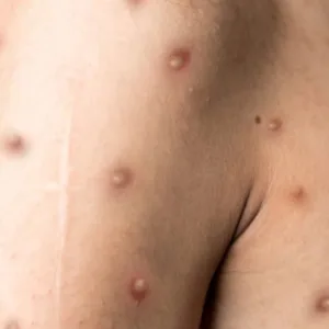 Porto Alegre confirma primeiro caso de mpox