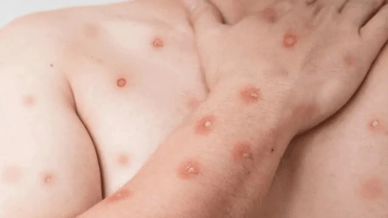 RJ confirma 11 casos de Mpox em 2026