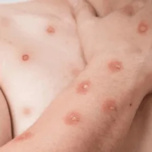 RJ confirma 11 casos de Mpox em 2026