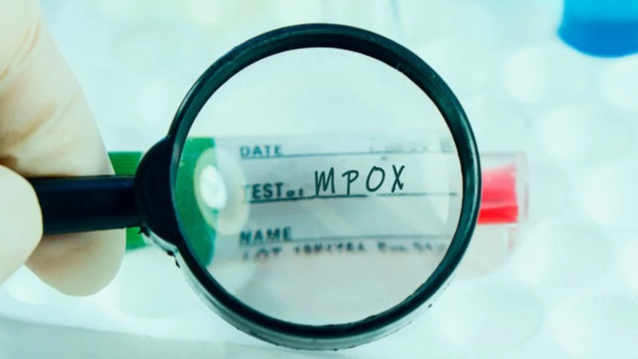 Saúde de SC investiga sete casos de Mpox no estado