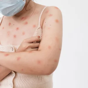 Sete casos suspeitos de Mpox são registrados em SC