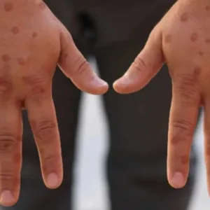 OMS alerta para nova variante da mpox e falha em antiviral | Foto: reprodução/GOV 