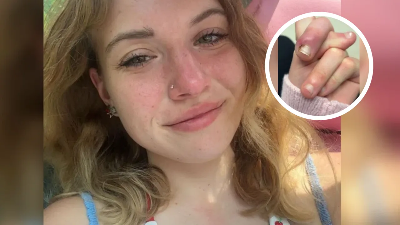 Jovem desenvolve infecção grave após roer unhas