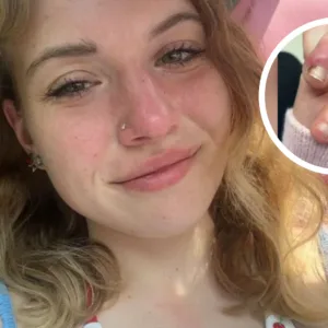 Jovem desenvolve infecção grave após roer unhas