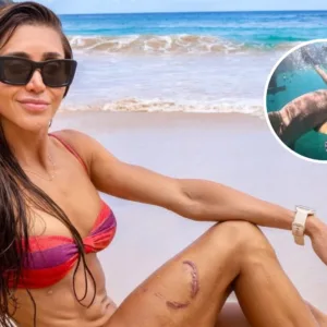 VÍDEO três meses após ataque, turista revela novo ângulo da mordida de tubarão