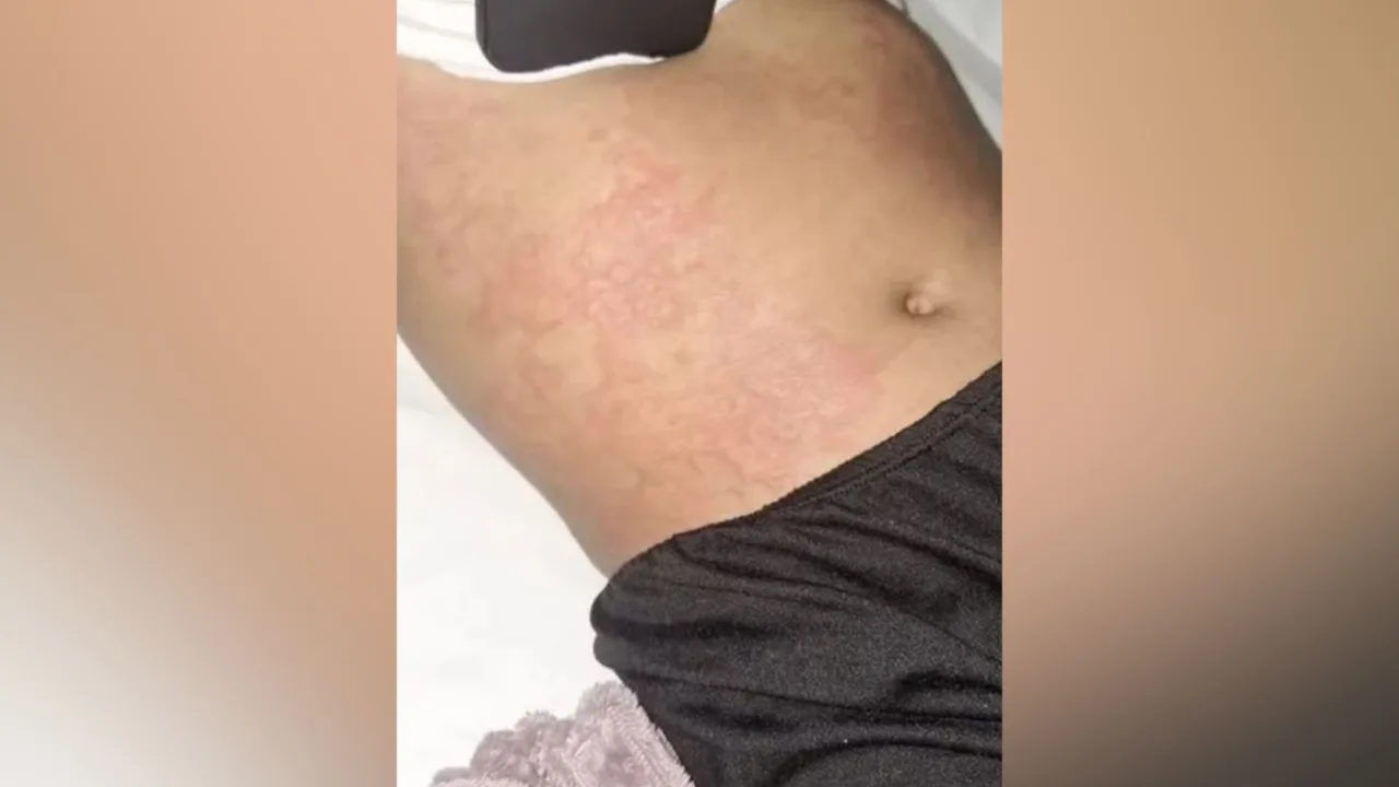 Criança é internada após suposta reação alérgica ligada a detergente da Ypê