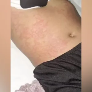 Criança é internada após suposta reação alérgica ligada a detergente da Ypê