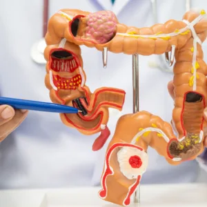 Novo teste no SUS promete ampliar diagnóstico precoce do câncer colorretal
