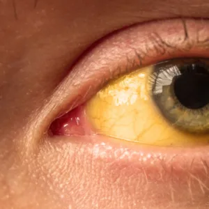 Julho Amarelo reforça prevenção de hepatites virais